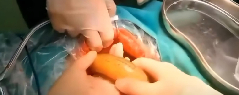 奇葩男子灌肠把30厘米活黄鳝放入体内 后从肛门钻破送入急救 肠道医生MDT抢回一命