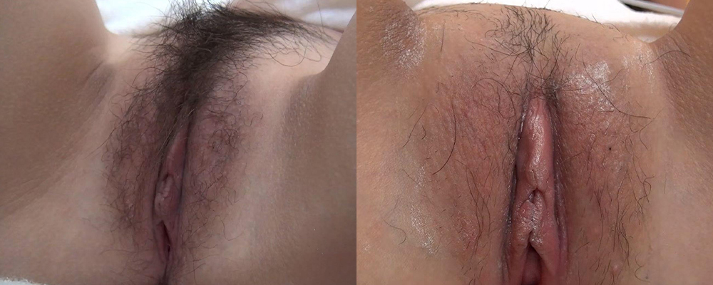 如何实现人造白虎神器 情侣现场实操示范如何清理私处阴毛 黑森林褪去展现女优同款蜜穴