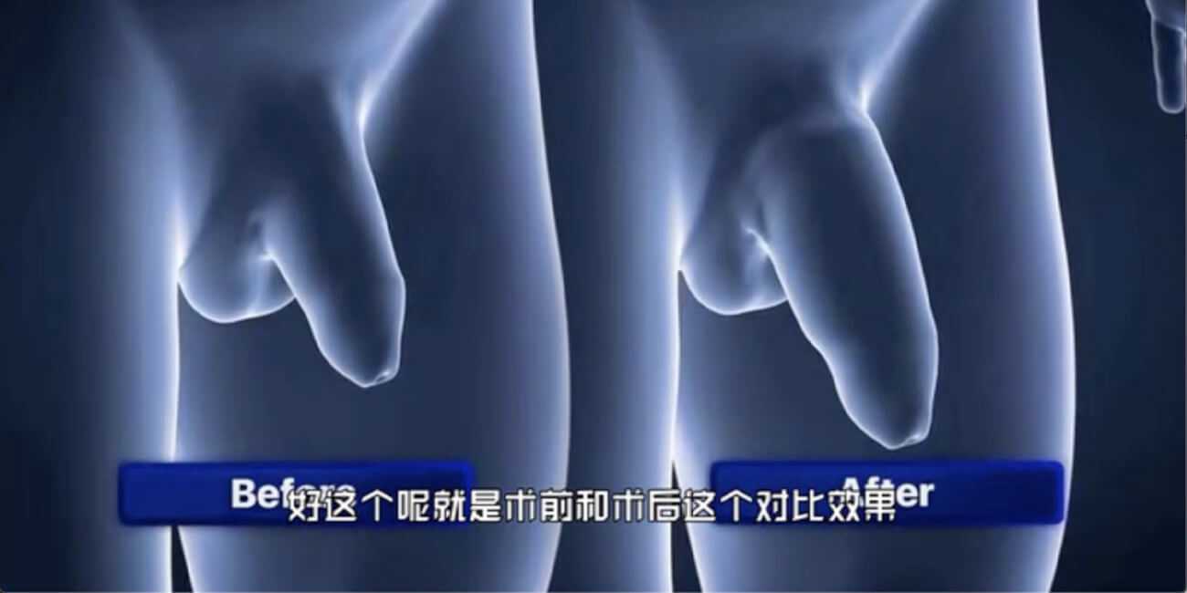 非手术性阴茎增大科普展示视频!细狗的兄弟们这下牛逼啦 真正的永久性增大增粗