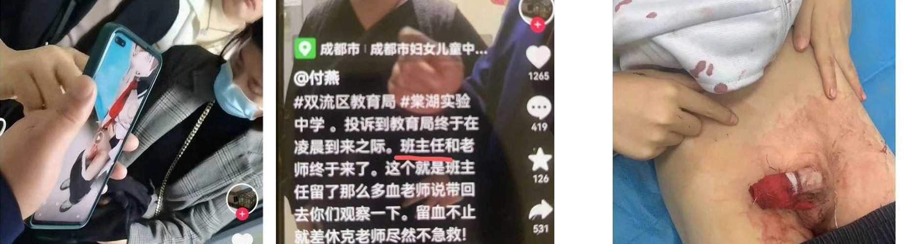 愤怒!成都双流 棠湖小学二年级学生被霸凌 鸡鸡被割了